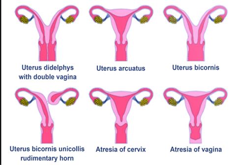 Uterine Didelphys: Causes, Symptoms, and Treatment